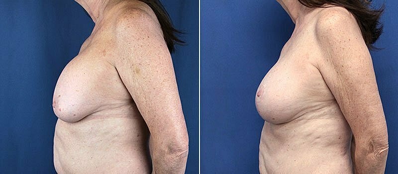 Secondary Revision Before & After