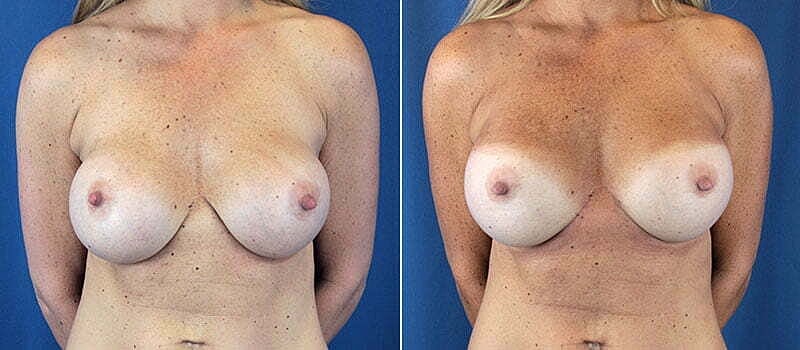 Secondary Revision Before & After