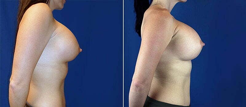 Secondary Revision Before & After