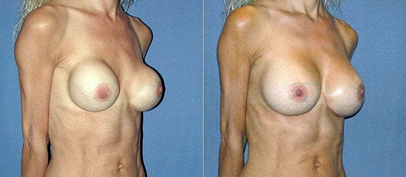 Secondary Revision Before & After