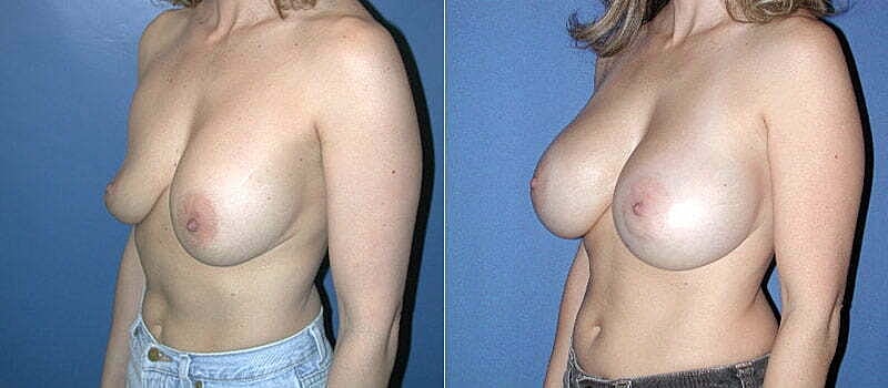 Secondary Revision Before & After