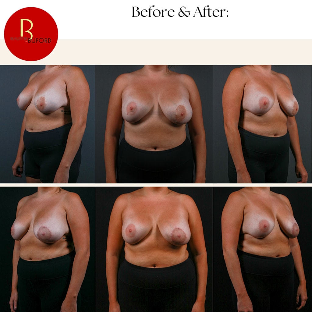 Breast Lift Before & After
