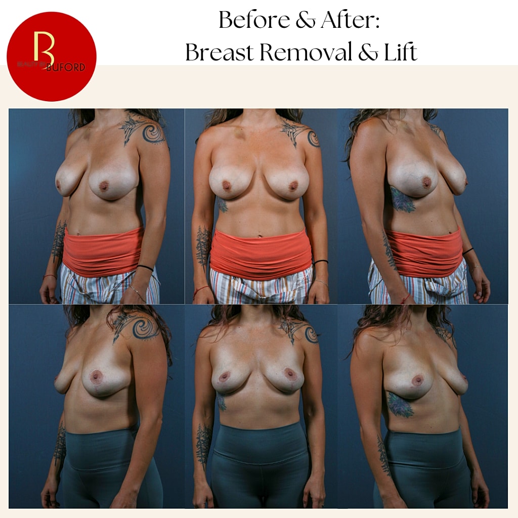 Breast Lift Before & After
