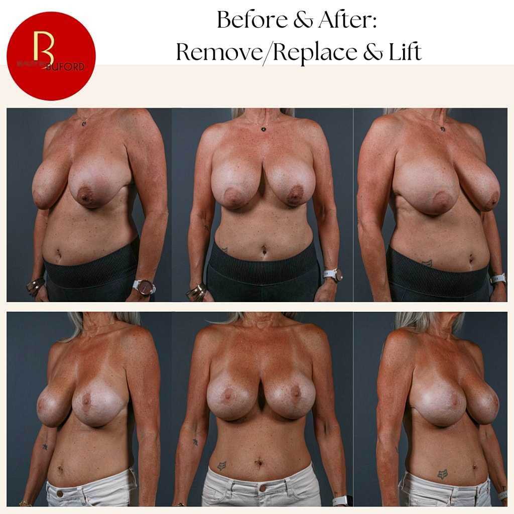 Breast Lift With Implants Before & After