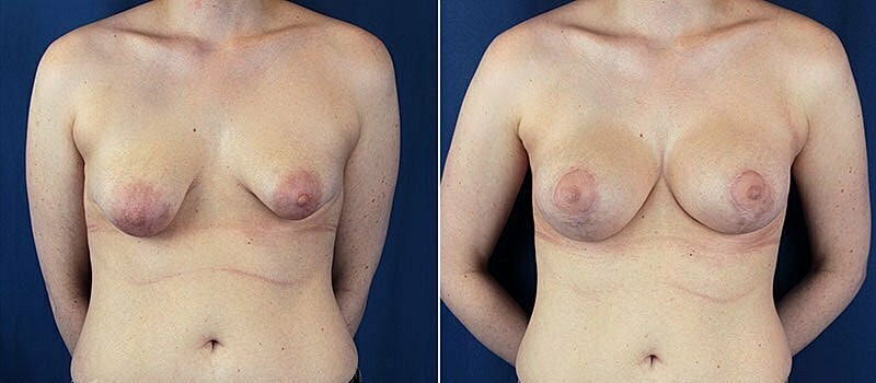 Breast Lift With Implants Before & After