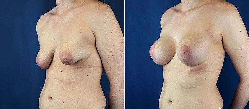 Breast Lift With Implants Before & After