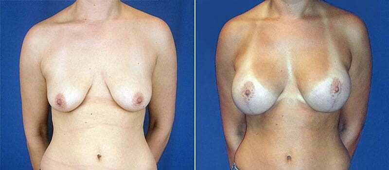 Breast Lift With Implants Before & After