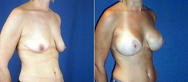 Breast Lift With Implants Before & After