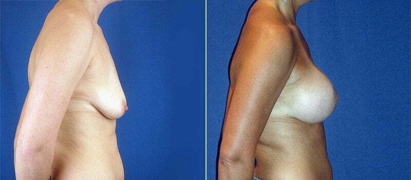 Breast Lift With Implants Before & After