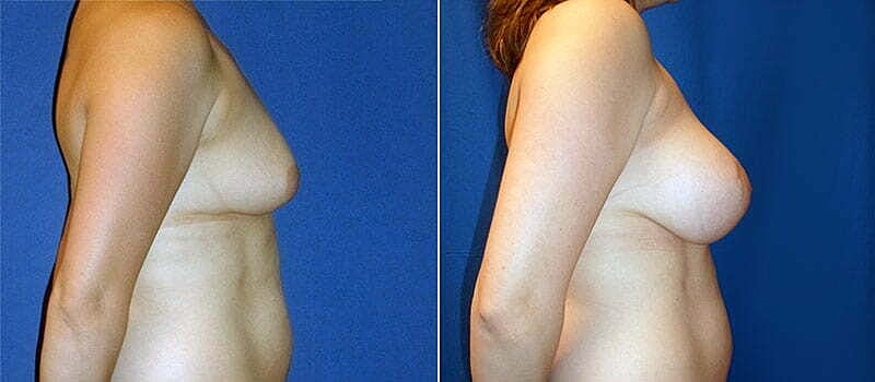Breast Lift With Implants Before & After
