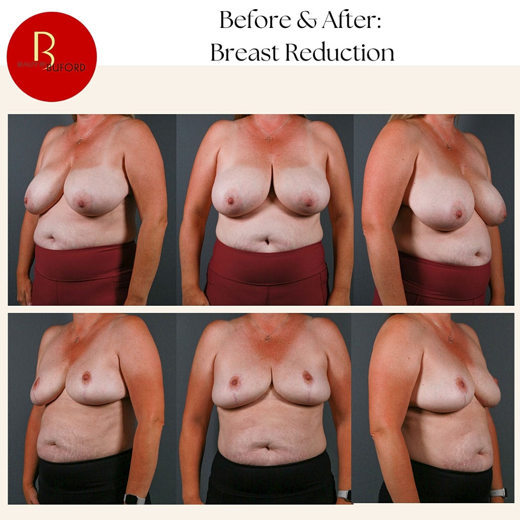 Breast Reduction Before & After