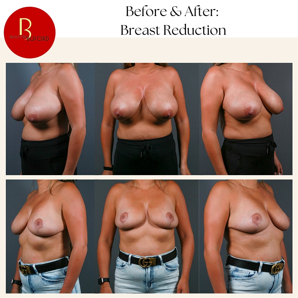 Breast Reduction Before & After