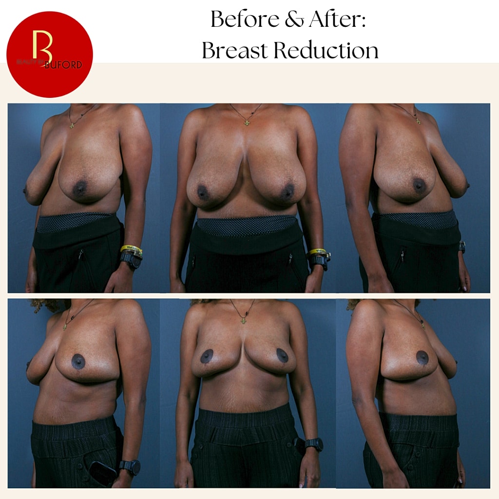 Breast Reduction Before & After