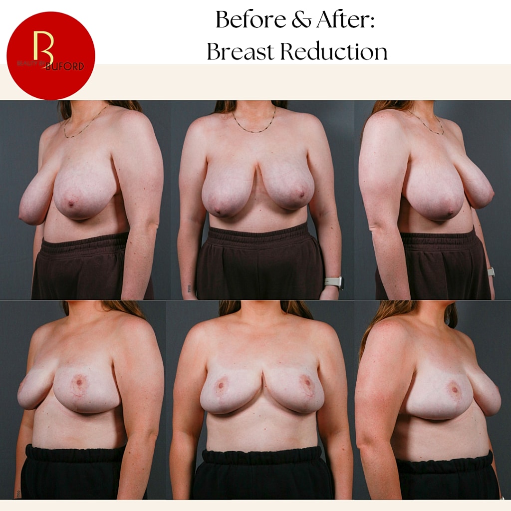 Breast Reduction Before & After