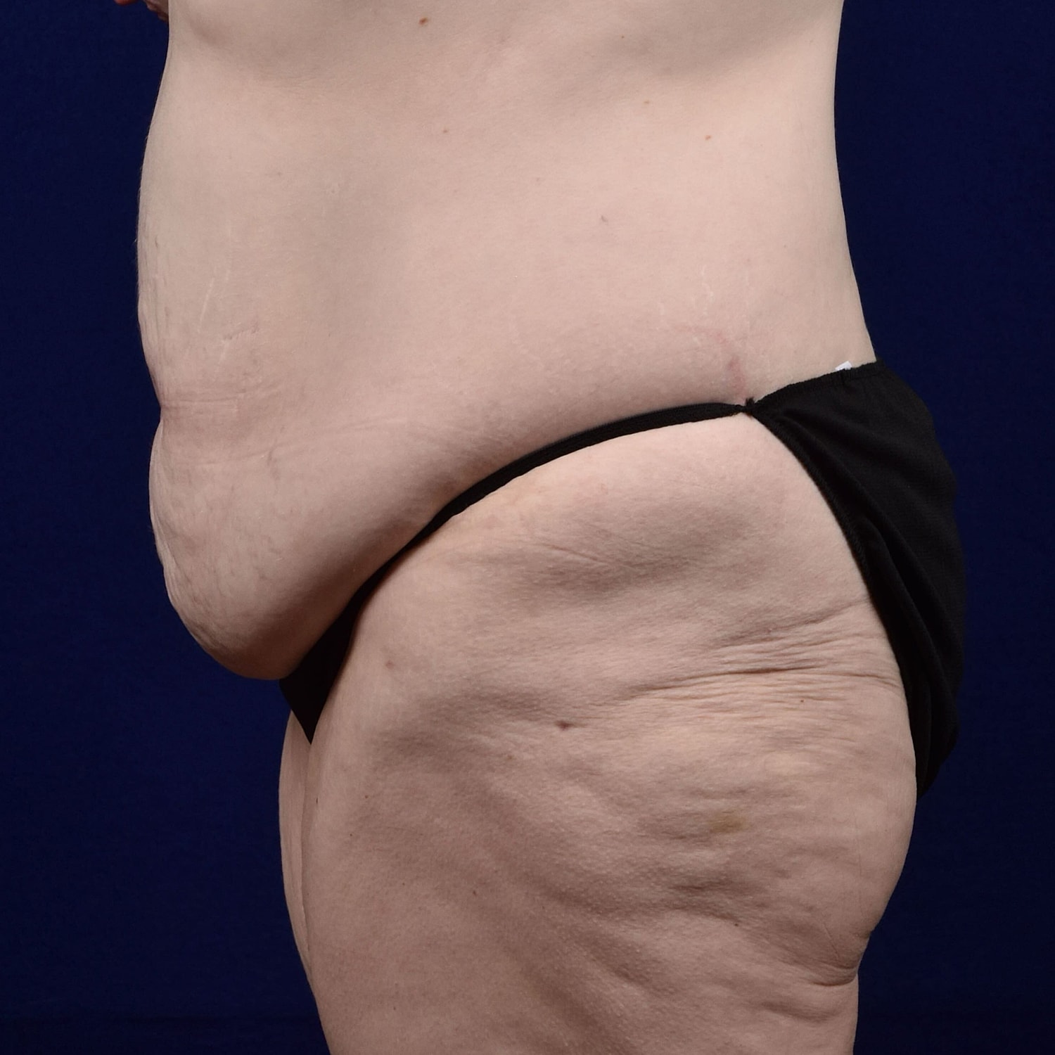 Abdominoplasty Lipo Before & After