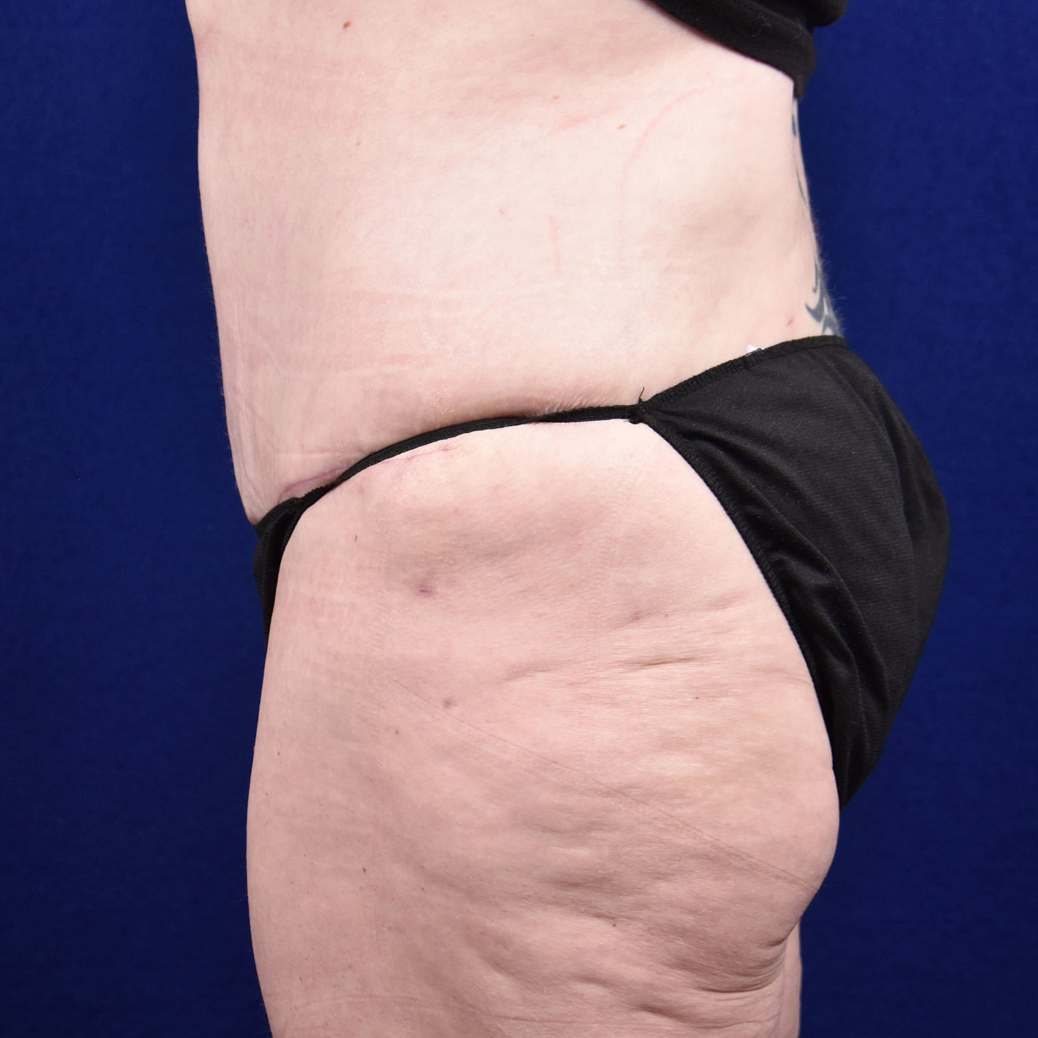 Abdominoplasty Lipo Before & After