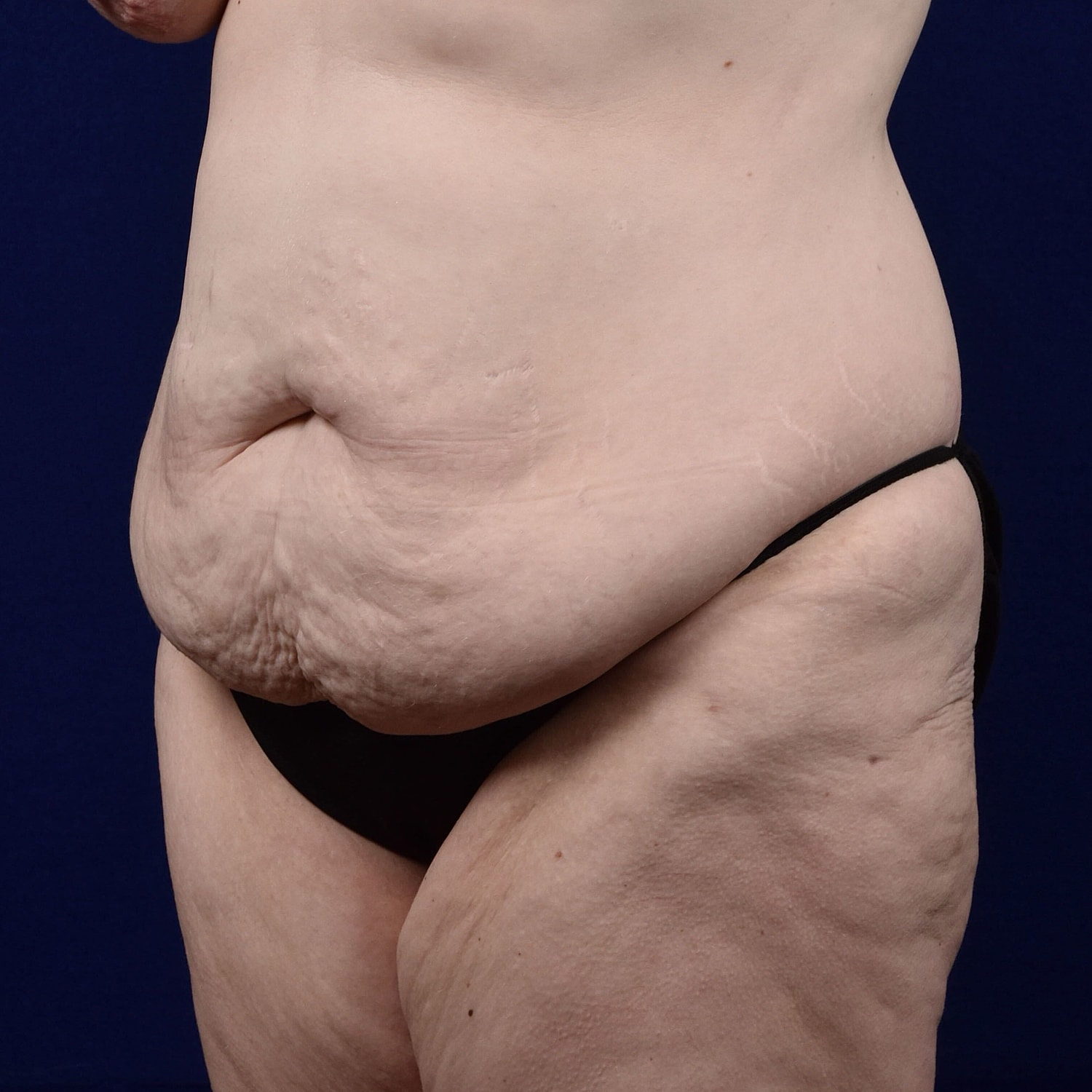 Abdominoplasty Lipo Before & After