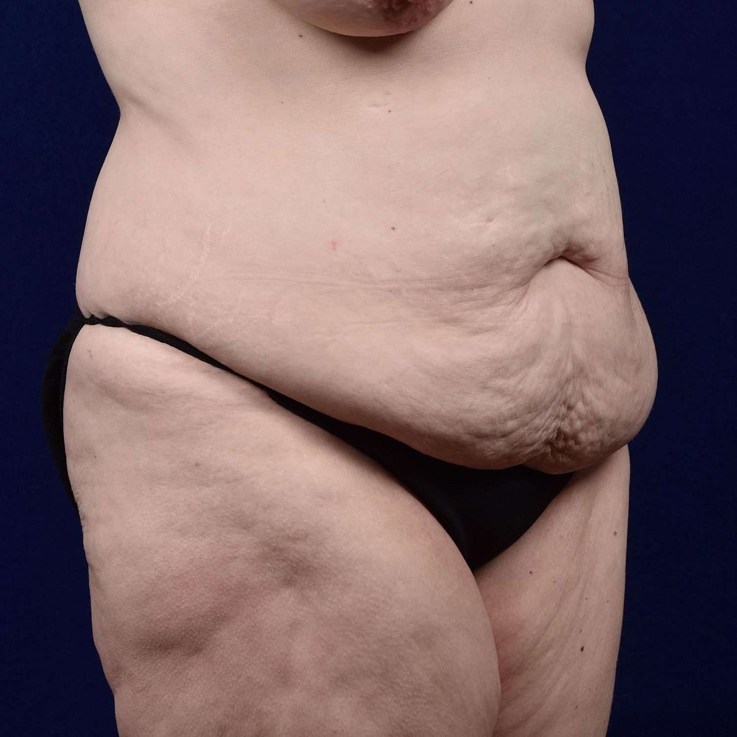 Abdominoplasty Lipo Before & After