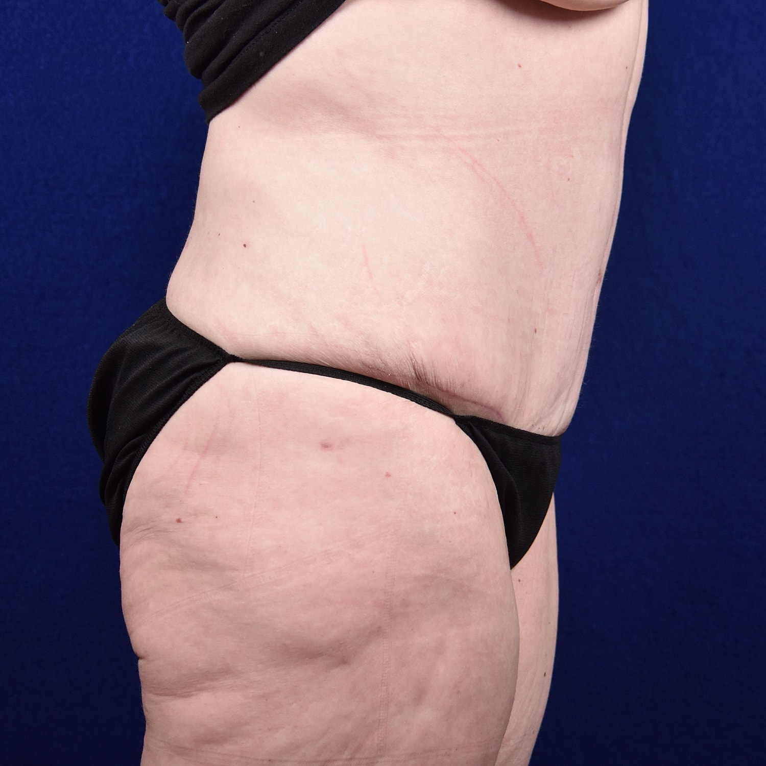Abdominoplasty Lipo Before & After