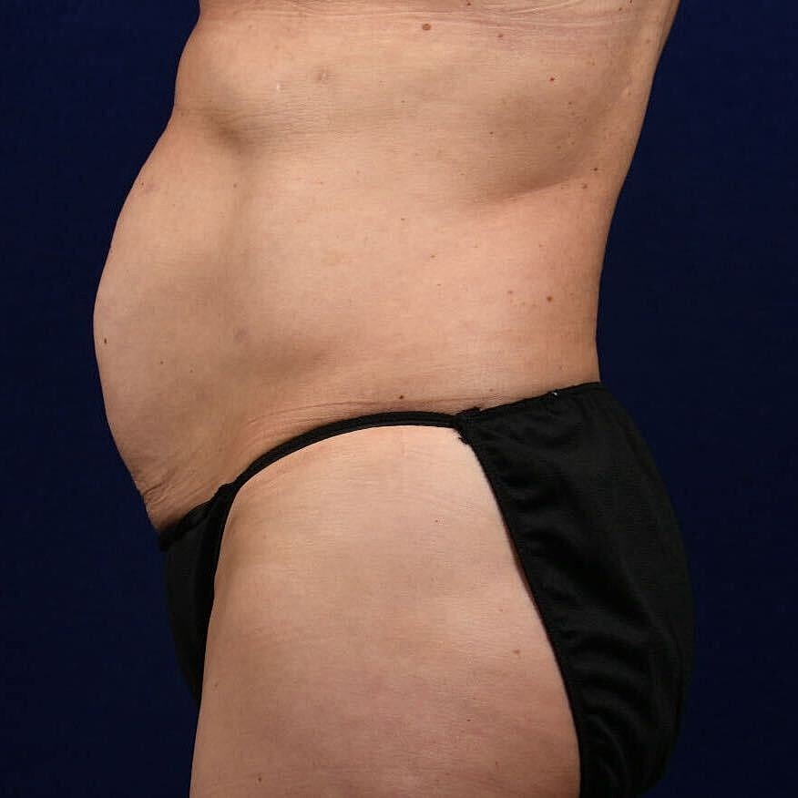 Abdominoplasty Lipo Before & After