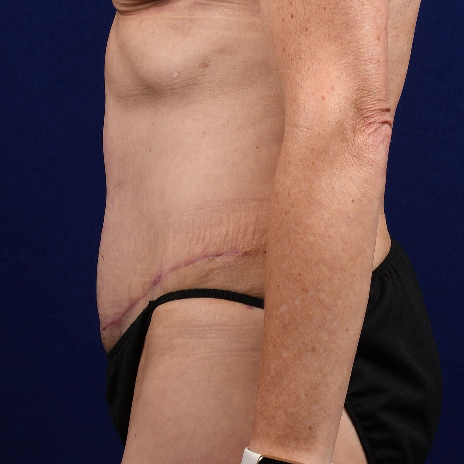 Abdominoplasty Lipo Before & After