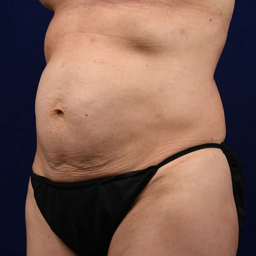 Abdominoplasty Lipo Before & After