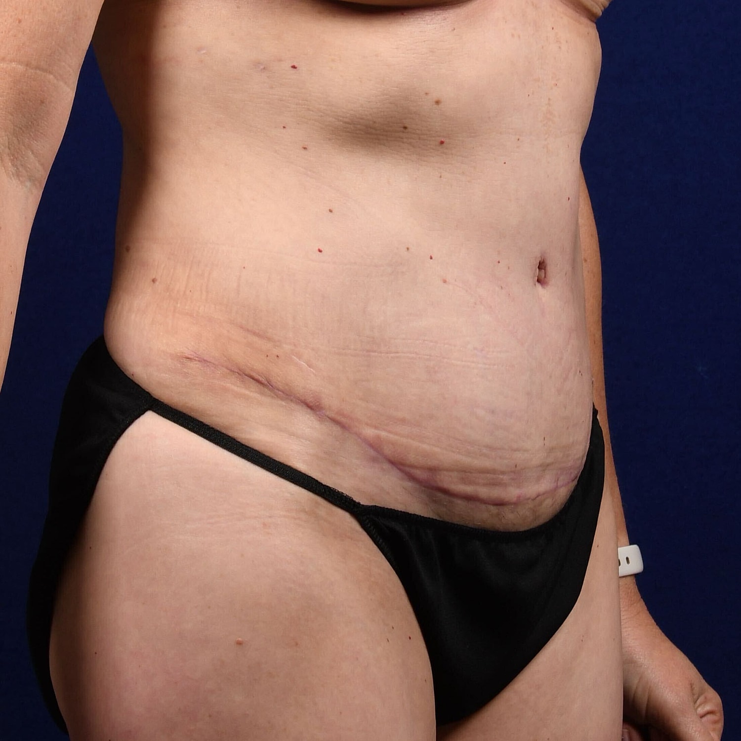 Abdominoplasty Lipo Before & After