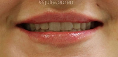 Lip Filler Before & After