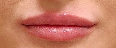 Lip Filler Before & After