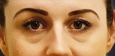 Tear Trough Filler Before & After